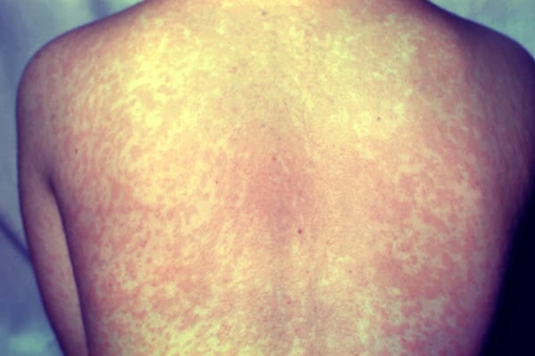 8 in 10 people who fell ill with measles during 2025 had not been vaccinated